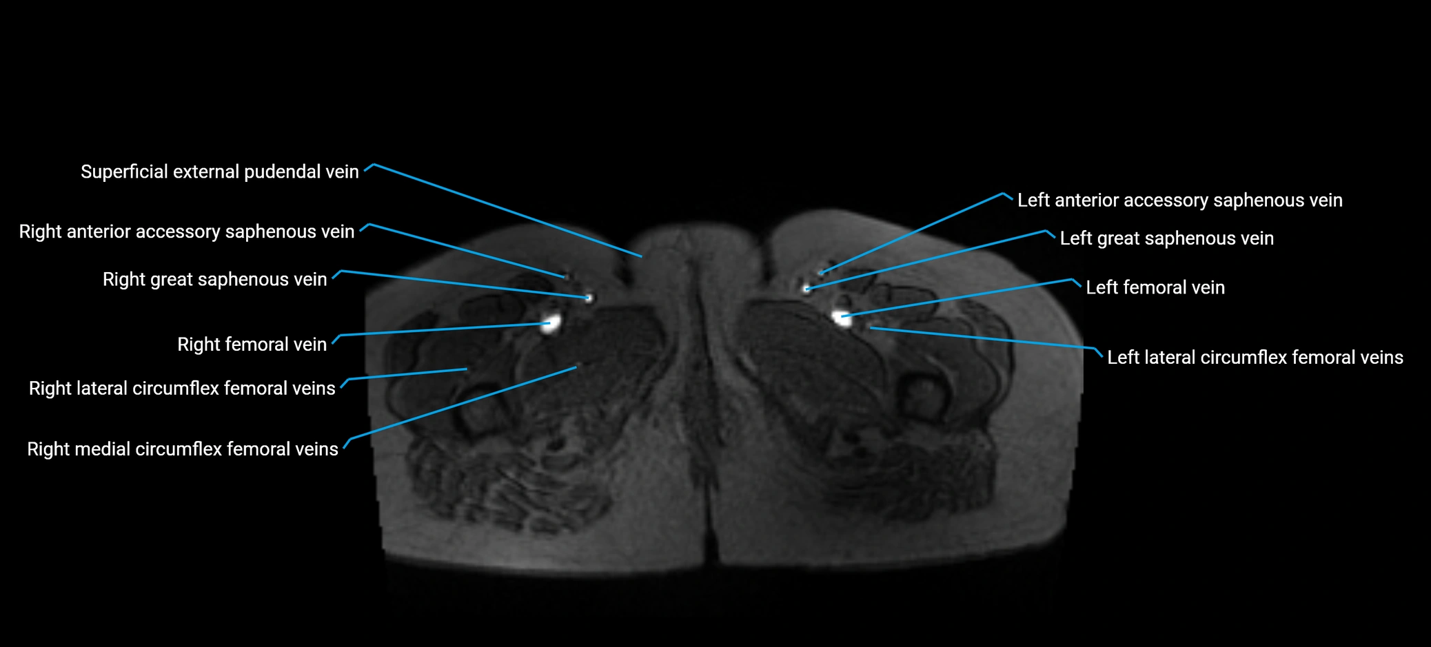 MRV abdomen pelvis & lower limb axial cross sectional anatomy labelled MRI image 207 (1).webp